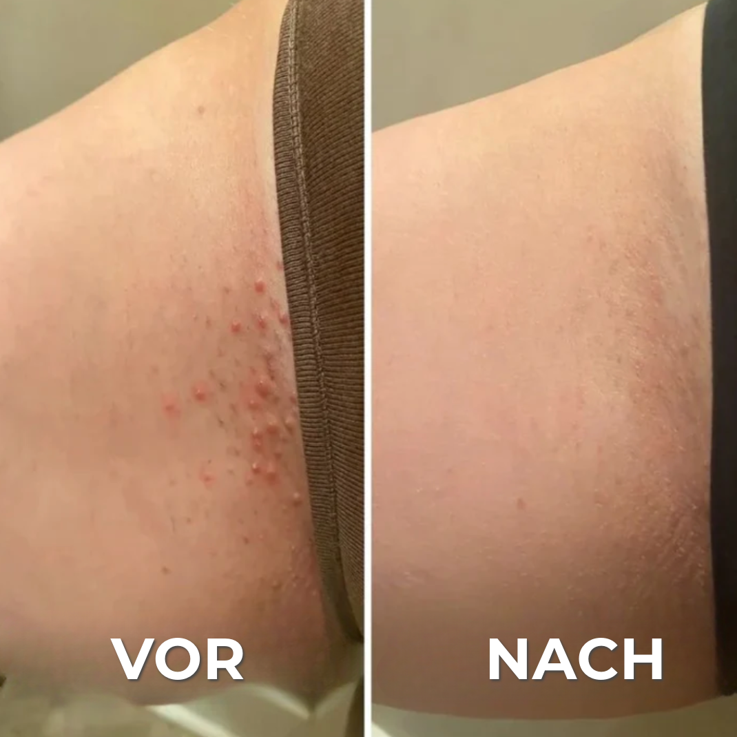 Professioneller Anti-Irritations-Rasierer